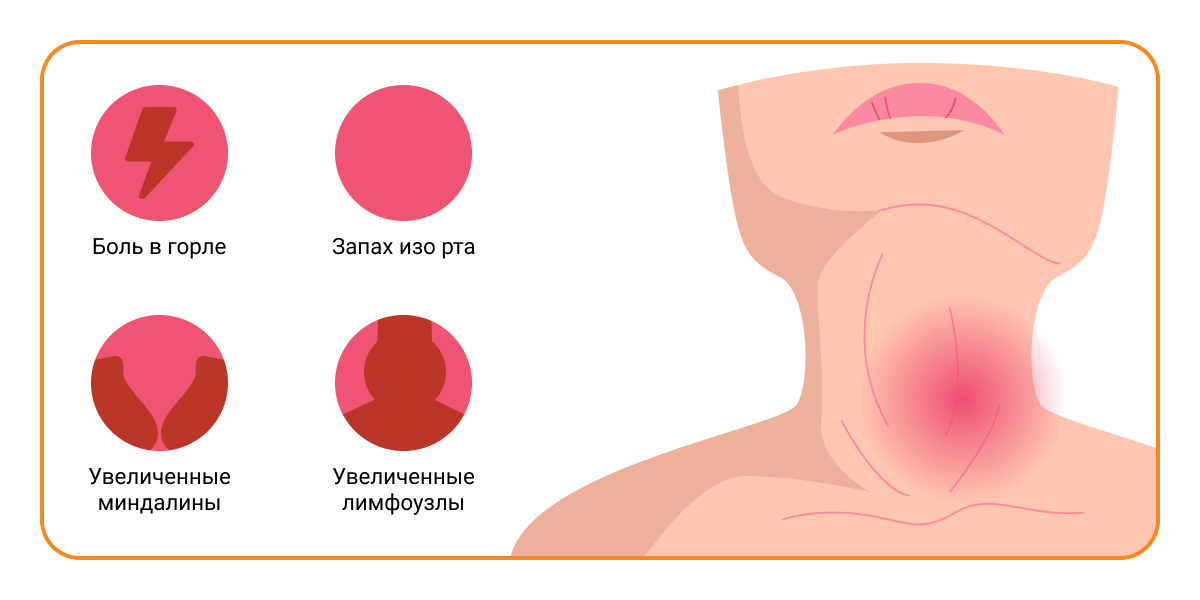 Симптомы хронического тонзиллита