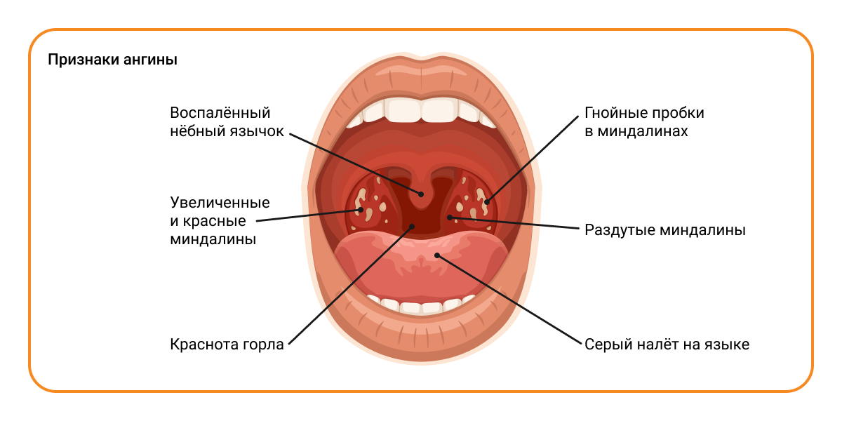 Признаки фолликулярной ангины