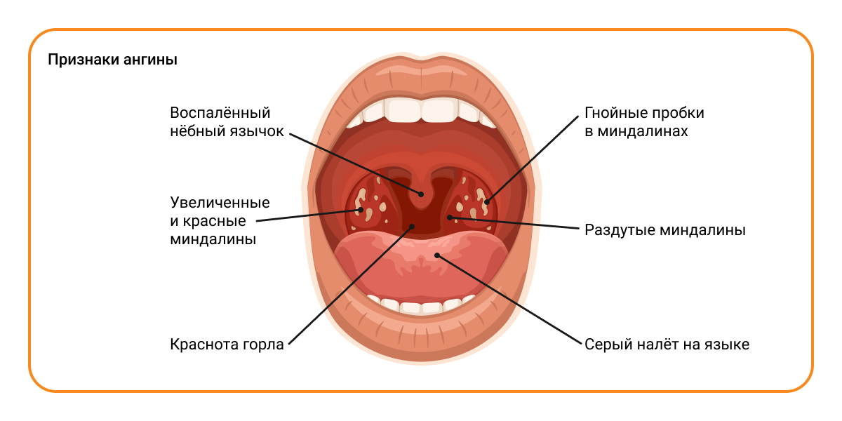 Лечение ангины, причины, виды заболевания, особенности клиники и жалоб — клиника «Добробут»