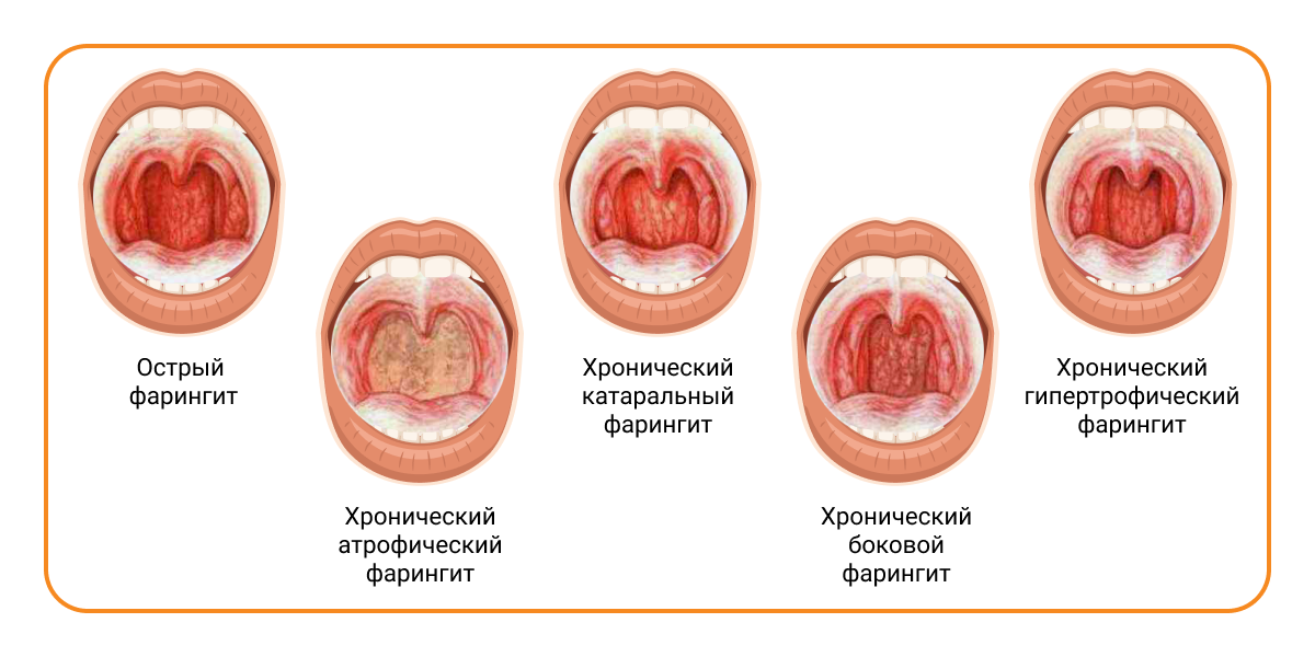 Рефлюксная болезнь