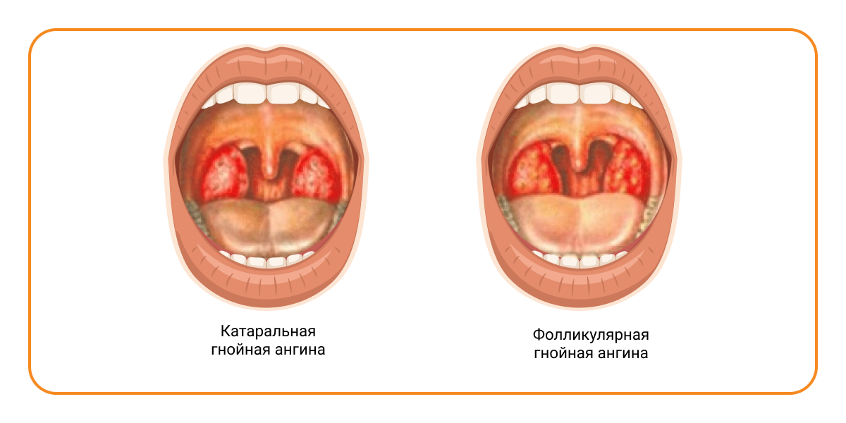 Формы ангины