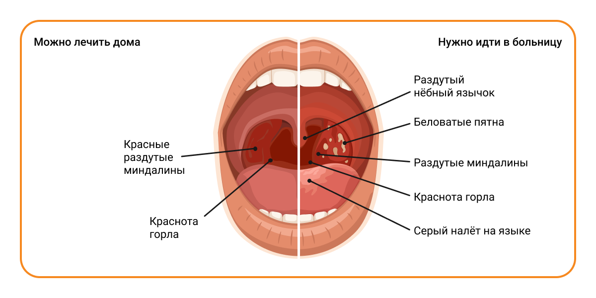 Поражения горла при ангине