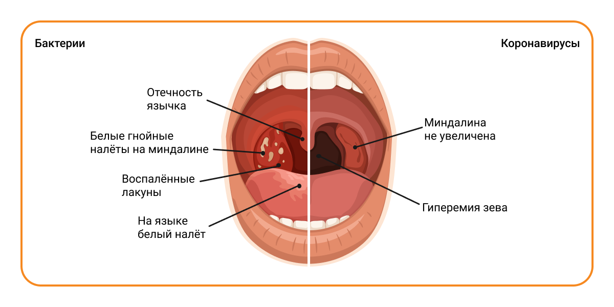 Признаки бактериальной и вирусной инфекций