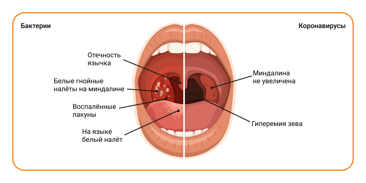 Почему бывает щекочет в горле: причины и способы облегчения