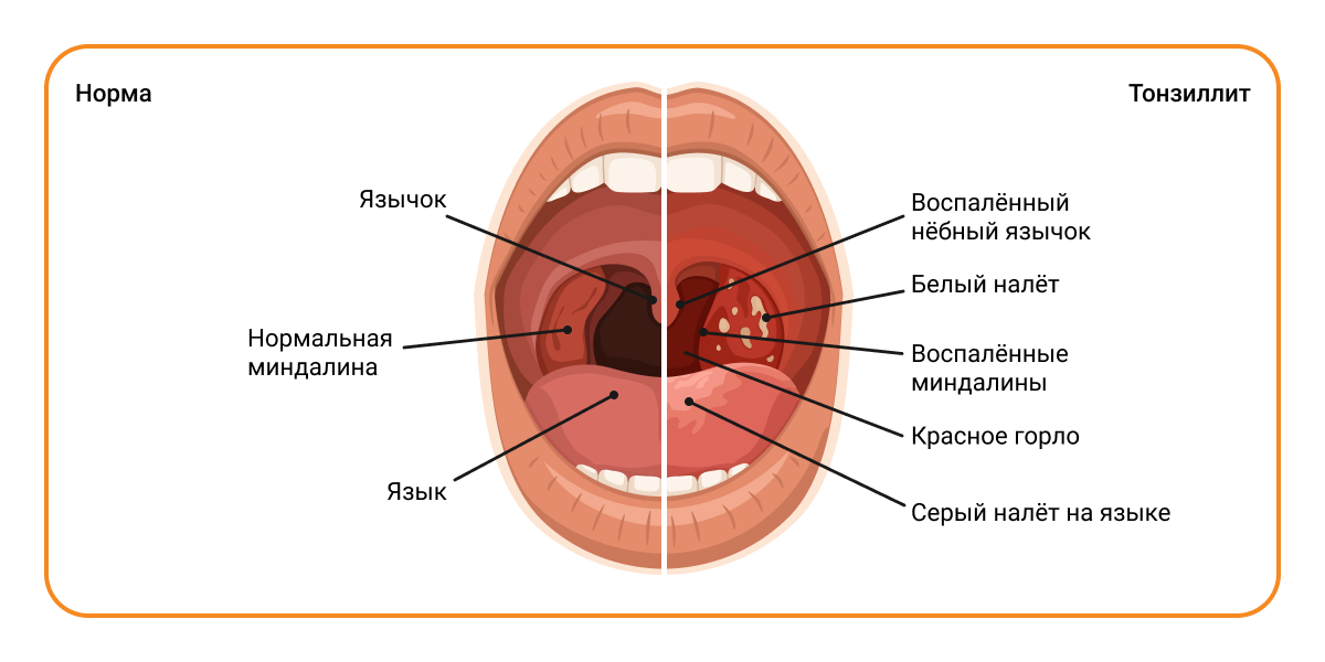 Острый тонзиллит