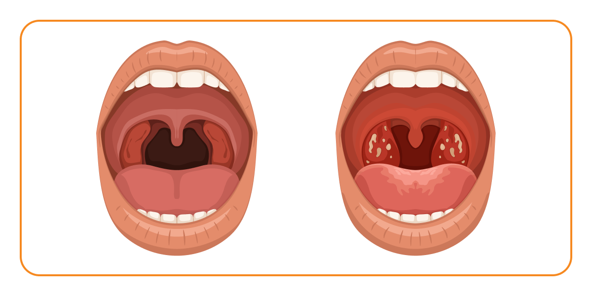 Вид горла при вирусной ангине