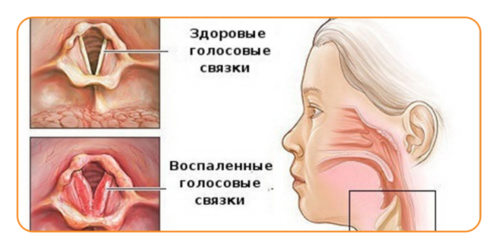 Почему пропадает. Инфильтративный ларингит. Подскладочный ларингит. Гипертрофический ларингит