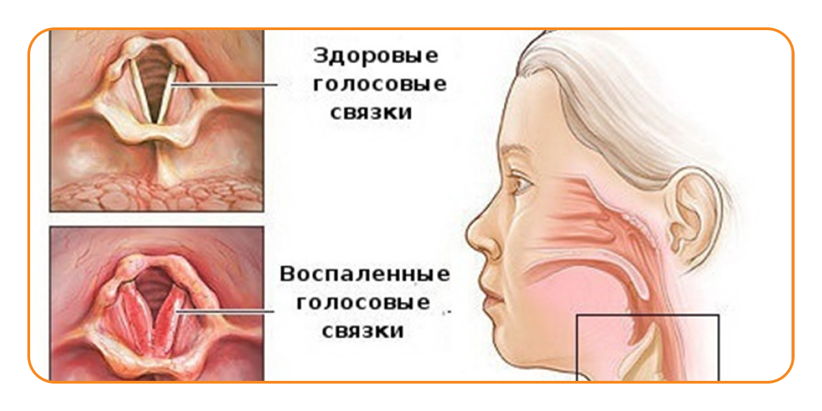Температура горло болит мокрота. Профилактика острого катарального ларингита. Острый и хронический ларингит симптомы. Острый ларингит у детей симптомы. Что такое хронический гипертрофический ларингит симптомы.