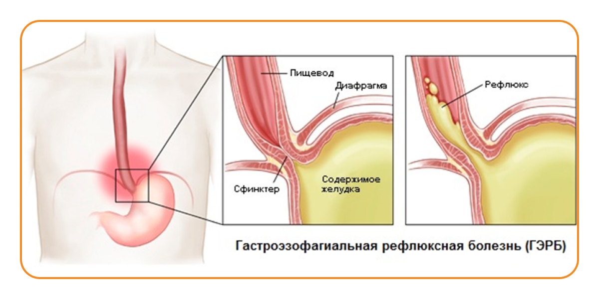 Кашель при простуде, гриппе и ОРВИ