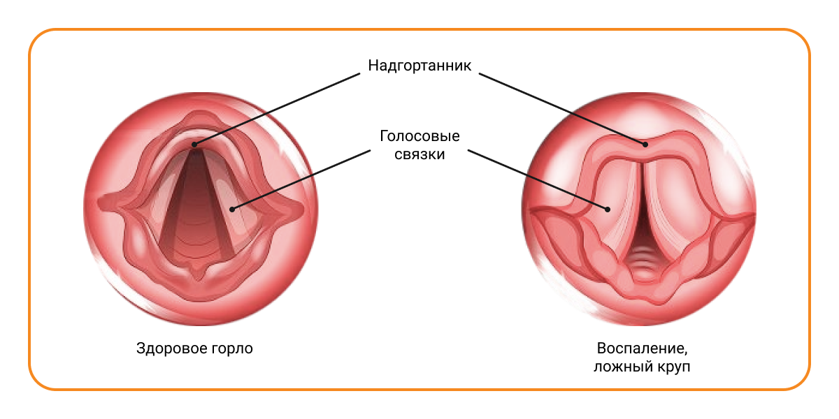 Laryngitis Guide: Causes, Symptoms and Treatment Options