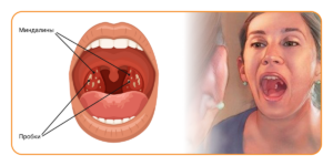 Как проявляется боль в горле?